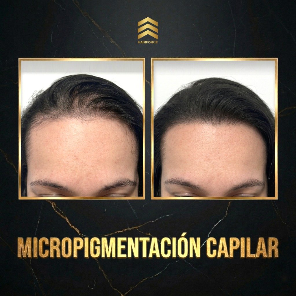 Anuncio de Micropigmentación capilar en México: Micropigmentación capilar