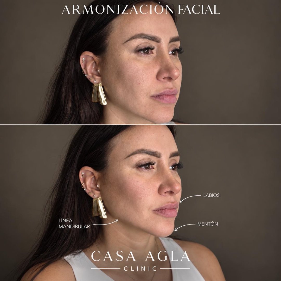 Anuncio de Casa Agla Body Studio: Armonización facial