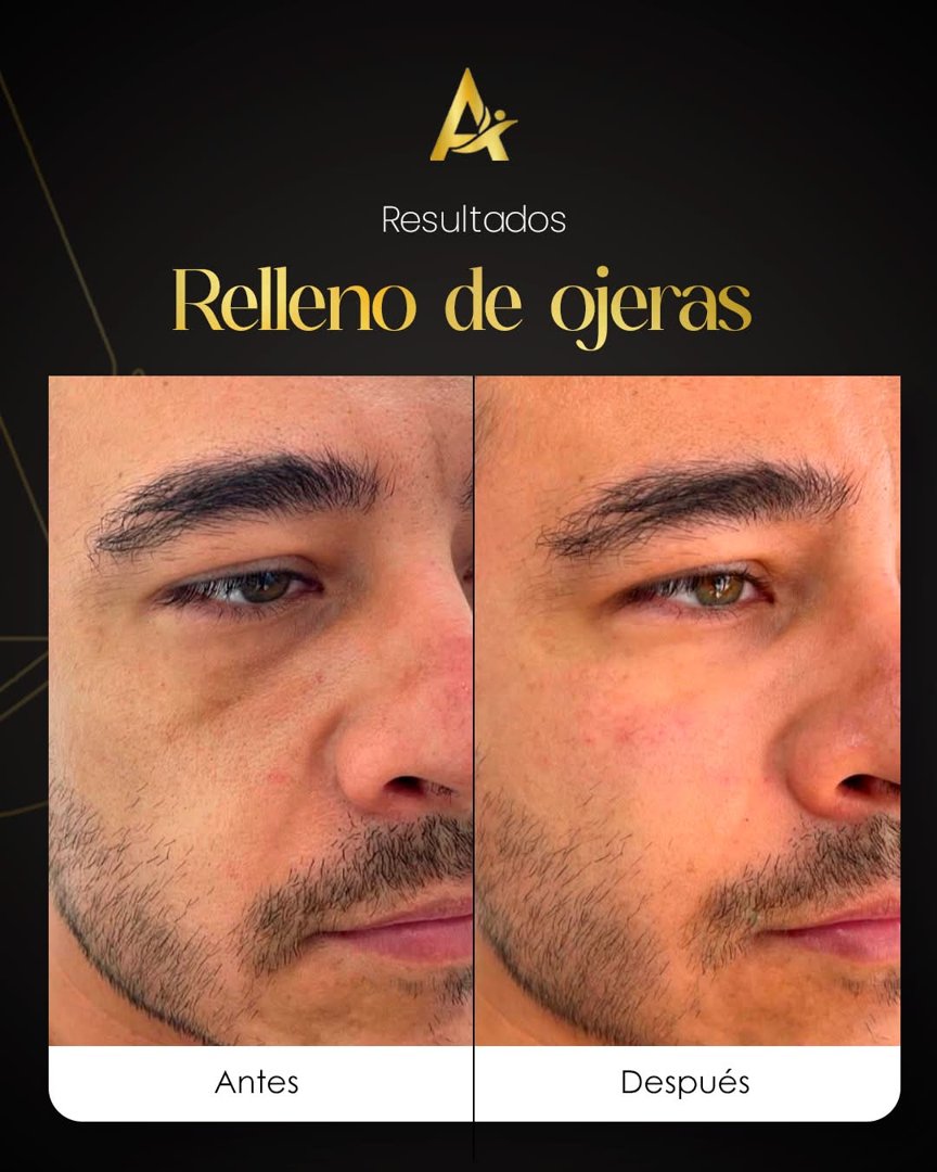 Anuncio de Dr. Carlos Aleman: relleno de ojeras