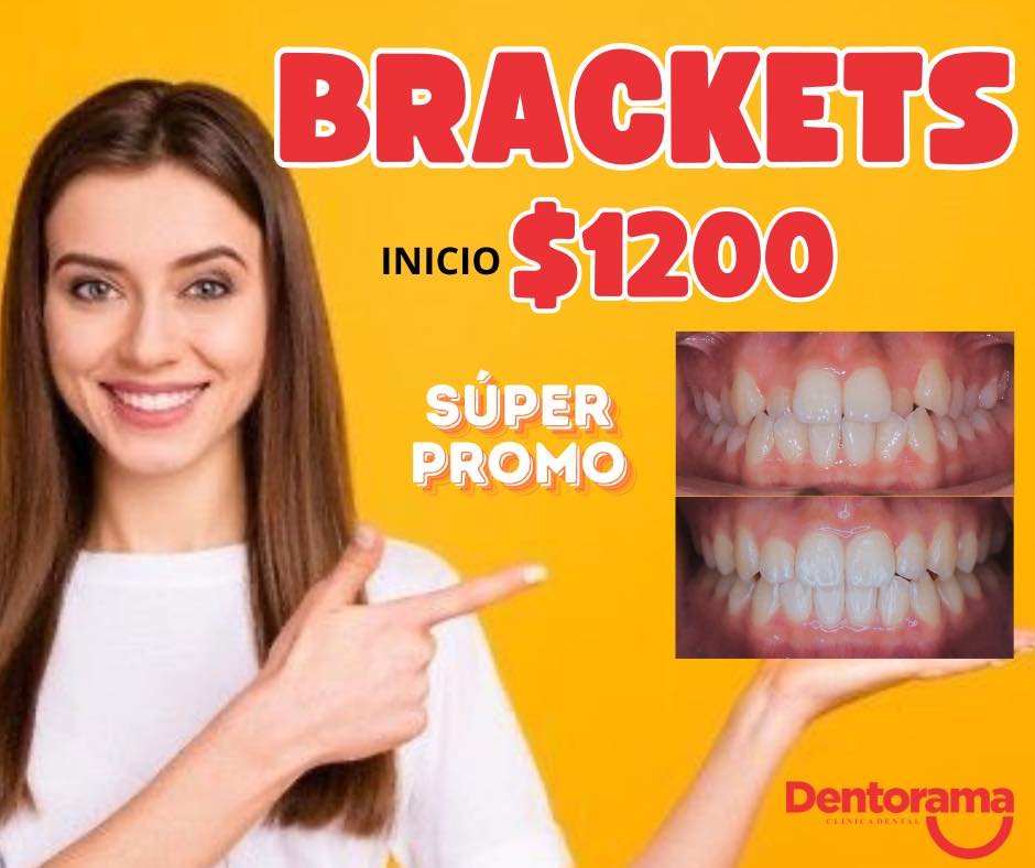 Anuncio de Dentorama Huejutla: Colocación de brackets