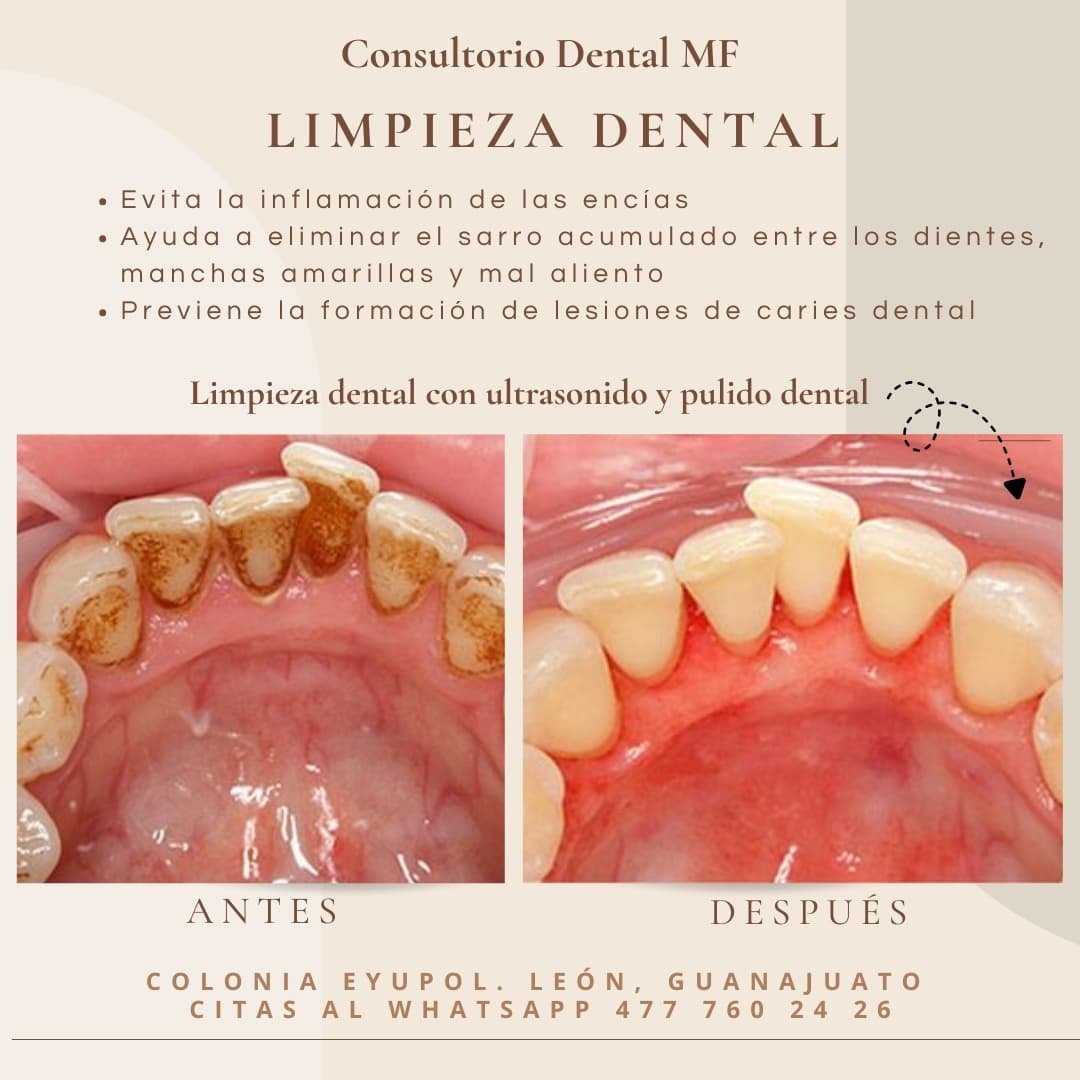 Anuncio de Dra Lupita: Limpieza dental