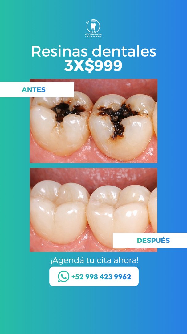 Anuncio de HG Odontología Integral: Resinas dentales