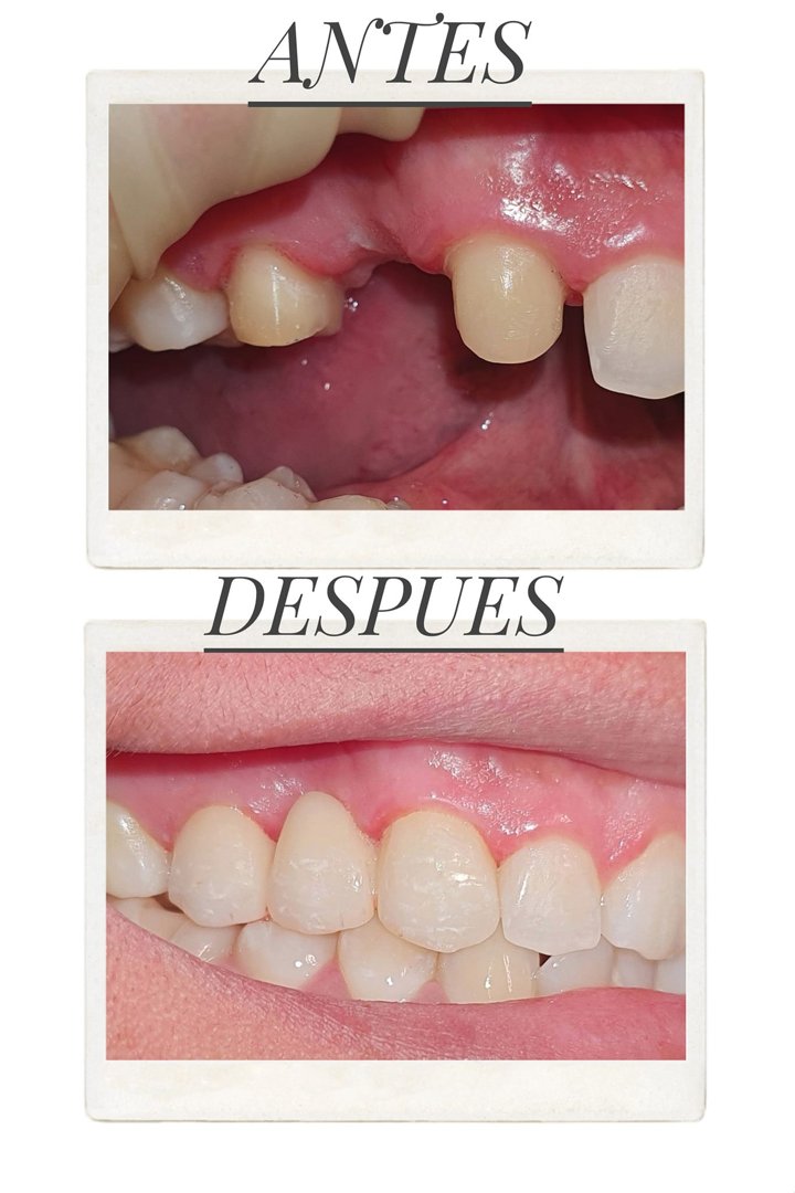 Anuncio de Dr. Derian Perez: Puente de zirconia